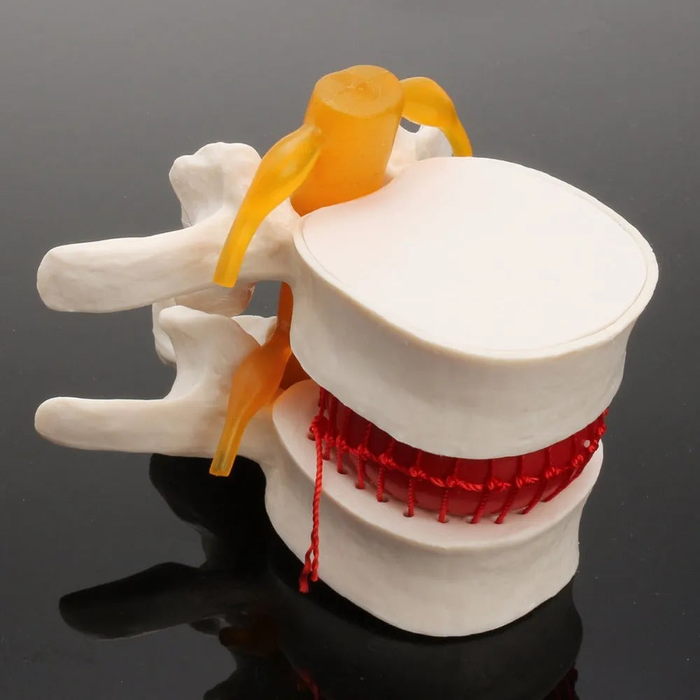 White PVC medical model of a herniated lumbar intervertebral disc for demonstration.