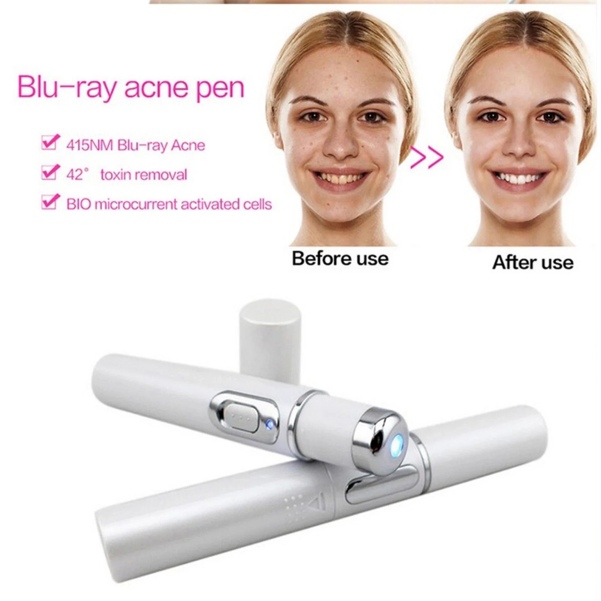 Blue Light Therapy Pen for Treating Acne, Scars, and Wrinkles - Portable Skincare Device with 415nm Blue Light, Heat, and Bio-Electric Current