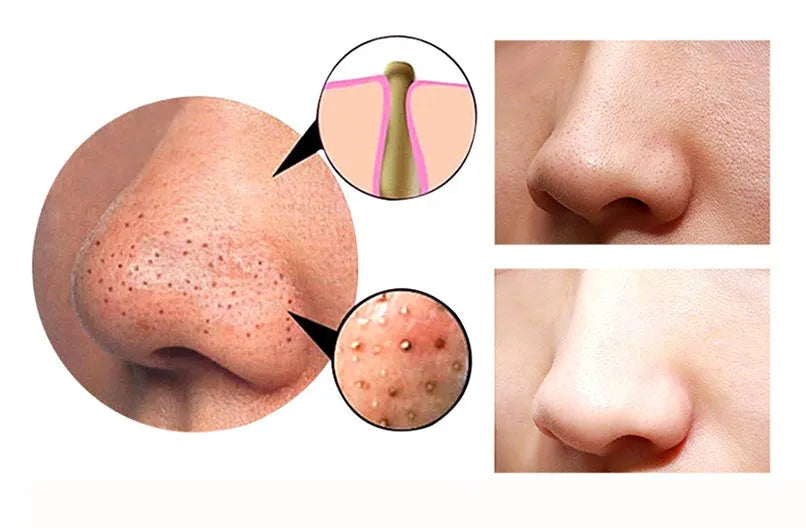 4 in 1 guasha cupping blackhead remover machine with suction heads and USB cable