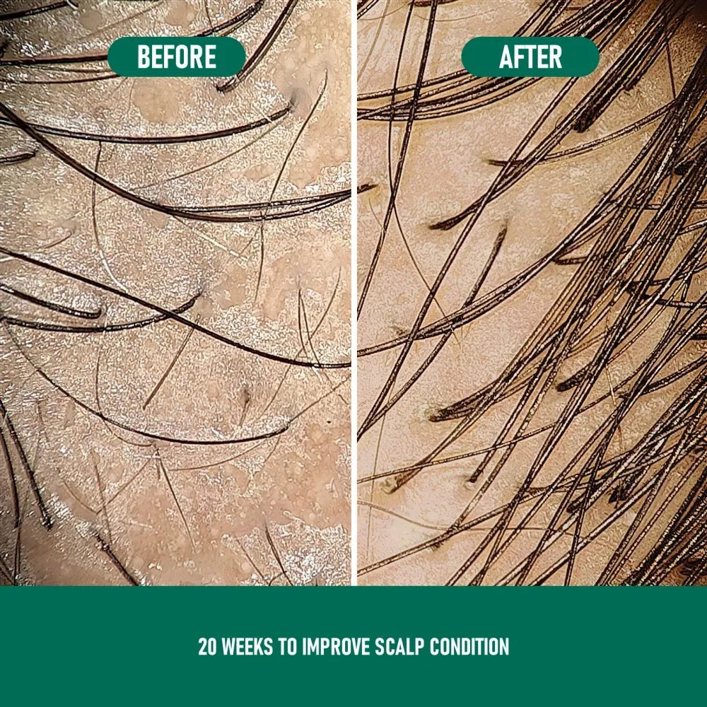 60ml canister of minoxidil anti-hair loss mousse foam with applicator.