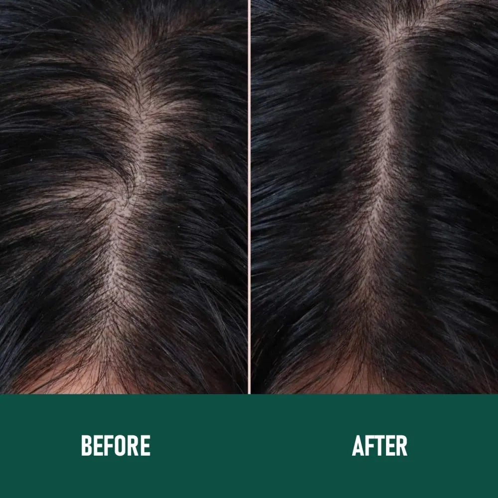 60ml canister of minoxidil anti-hair loss mousse foam with applicator.