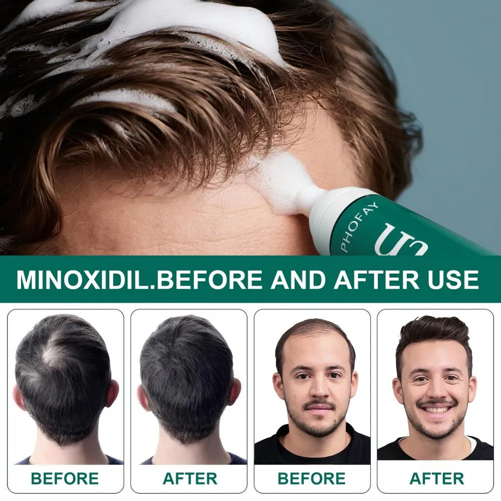 60ml canister of minoxidil anti-hair loss mousse foam with applicator.