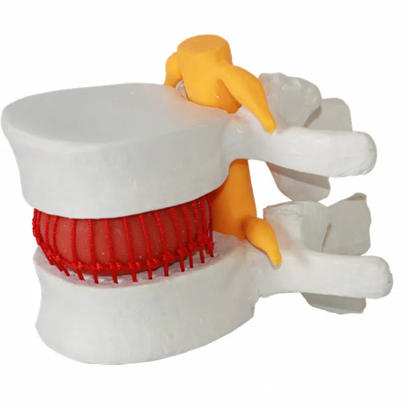 White PVC medical model of a herniated lumbar intervertebral disc for demonstration.