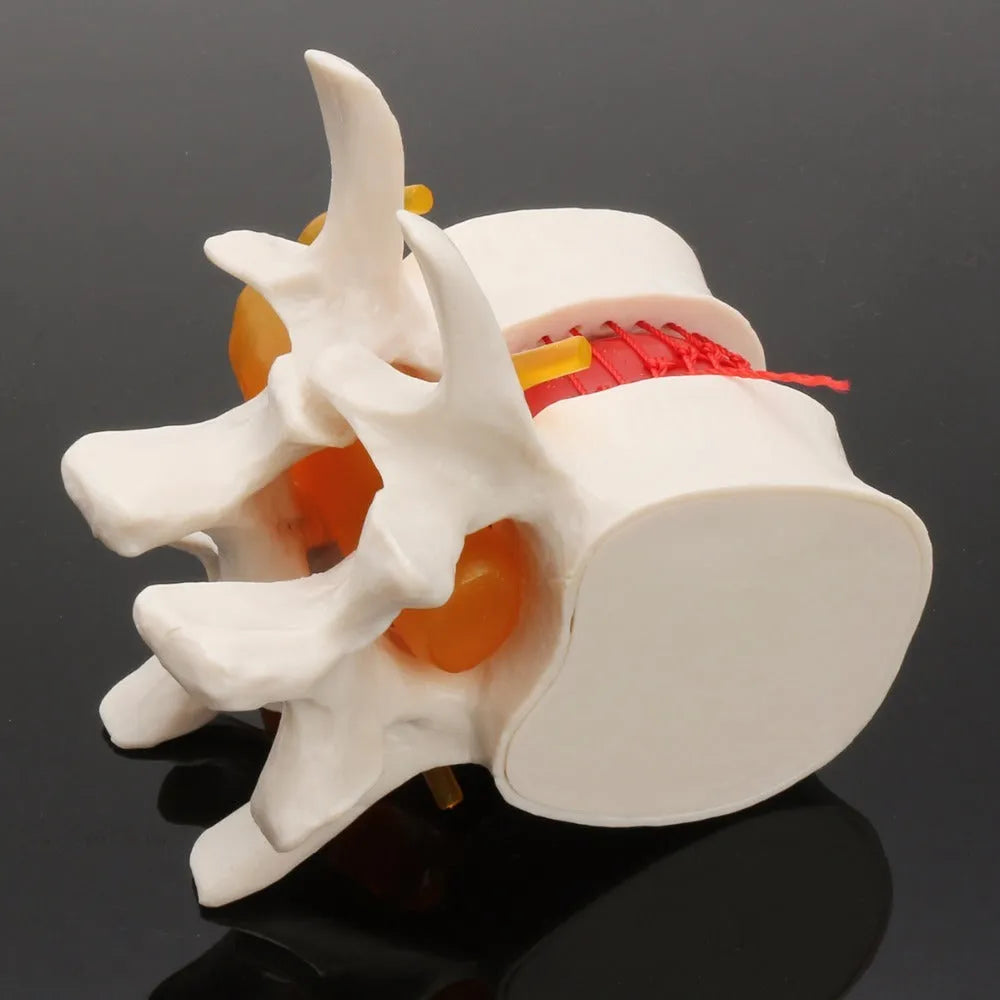 White PVC medical model of a herniated lumbar intervertebral disc for demonstration.