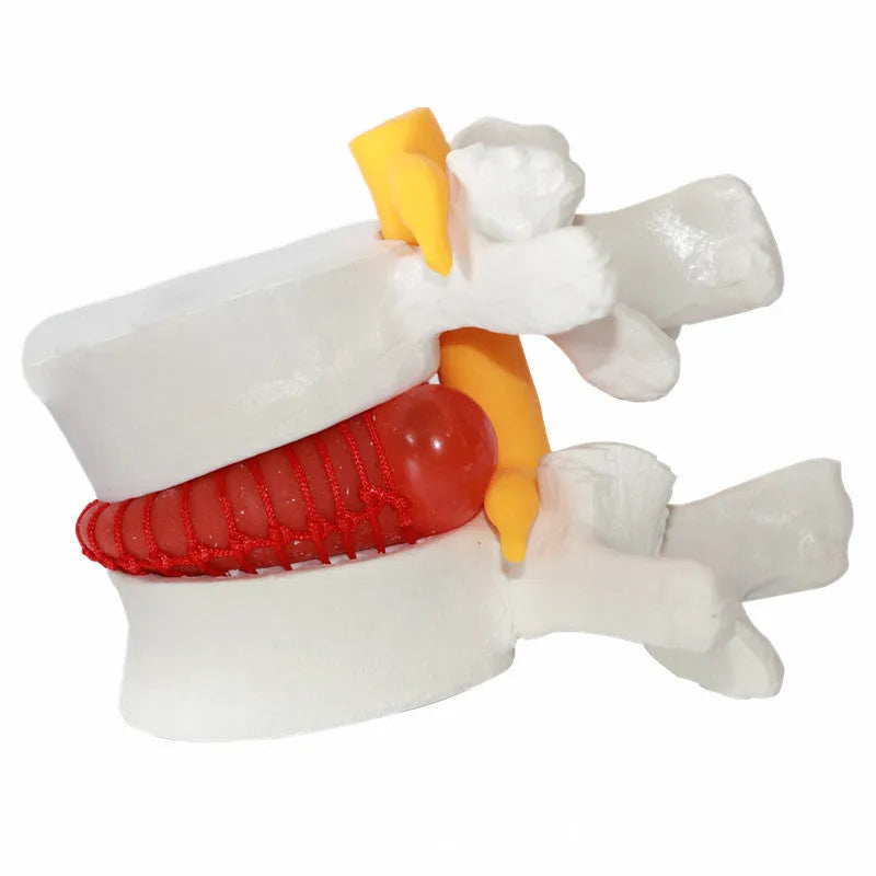White PVC medical model of a herniated lumbar intervertebral disc for demonstration.