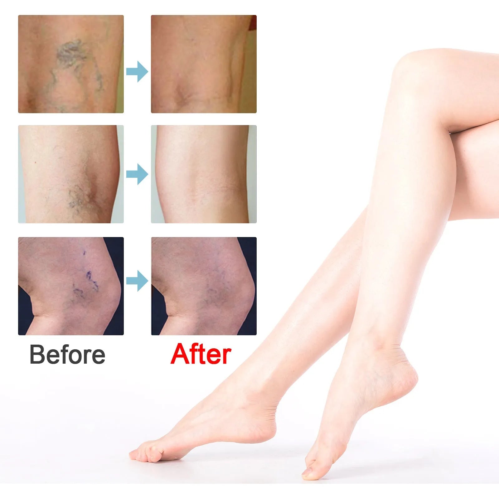 20g jar of vein repair cream for leg vein relief and visible blue-green vein reduction
