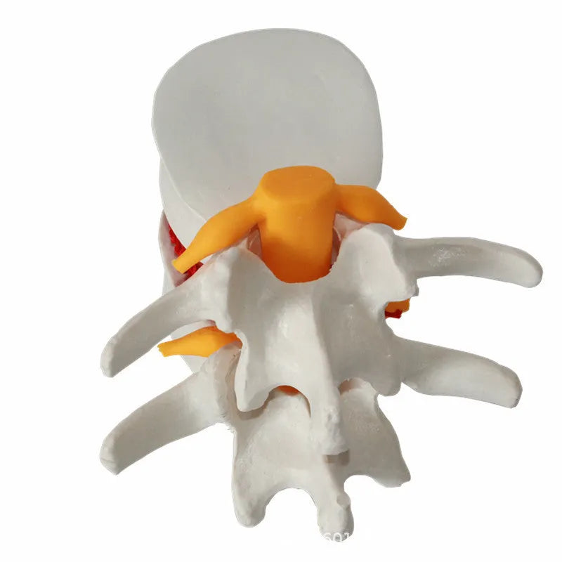 White PVC medical model of a herniated lumbar intervertebral disc for demonstration.
