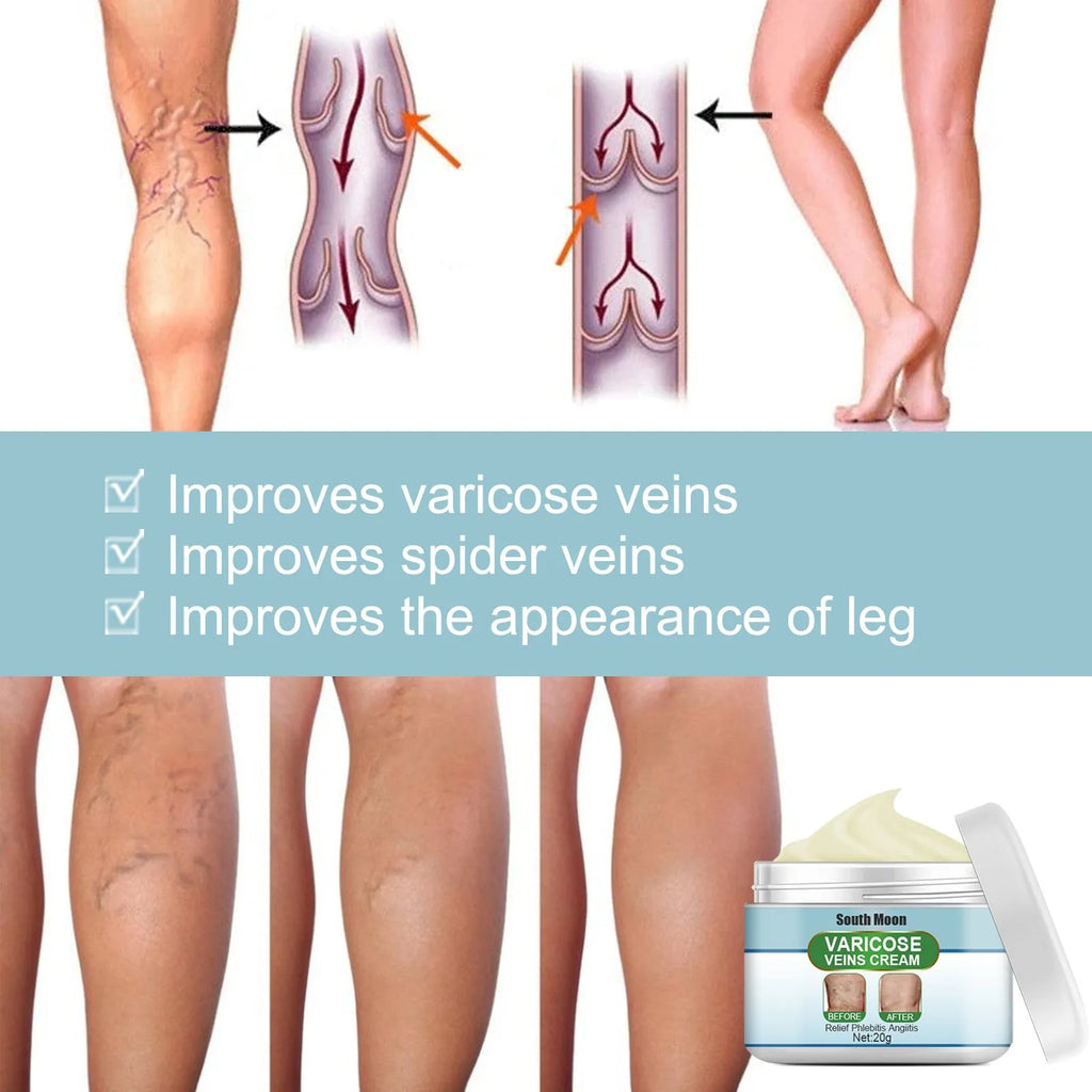 20g jar of vein repair cream for leg vein relief and visible blue-green vein reduction