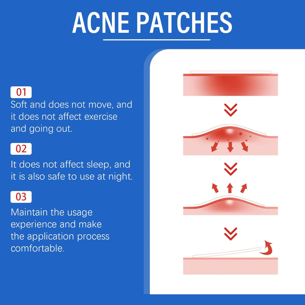 216-count acne patches with tea tree oil and vitamin E for facial blemish care