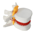 White PVC medical model of a herniated lumbar intervertebral disc for demonstration.