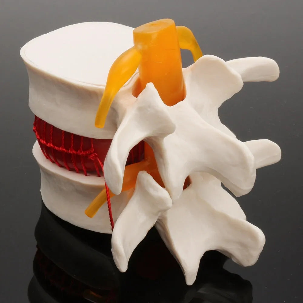 White PVC medical model of a herniated lumbar intervertebral disc for demonstration.