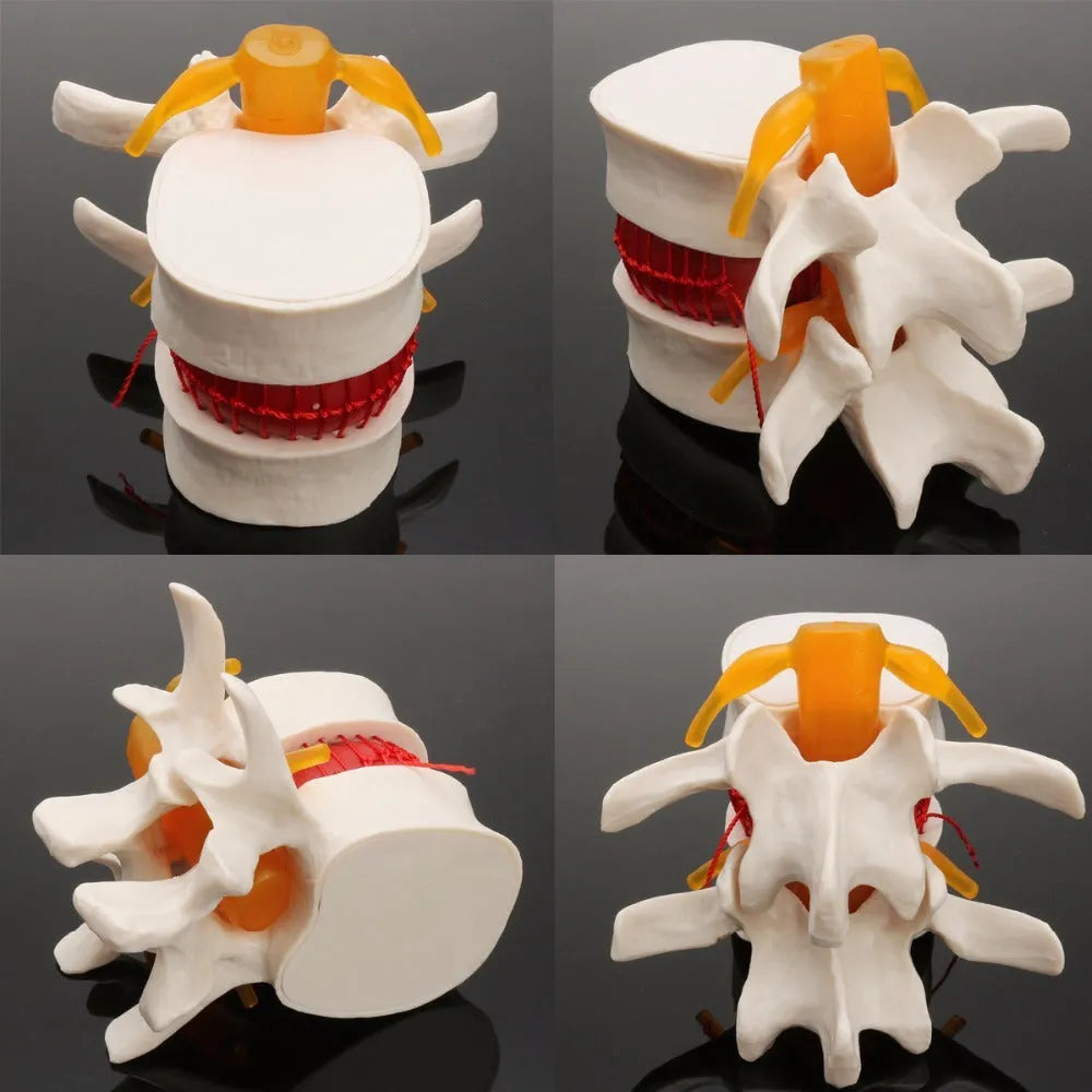 White PVC medical model of a herniated lumbar intervertebral disc for demonstration.