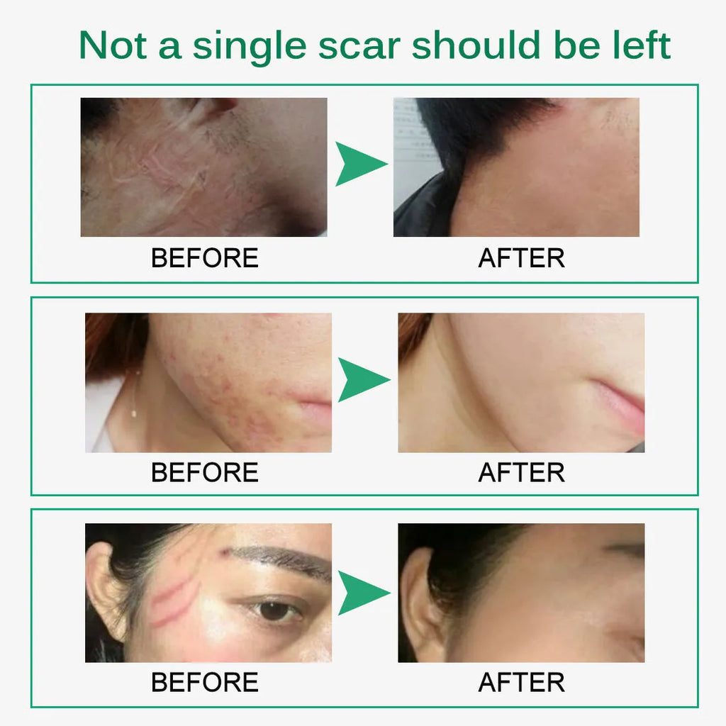 Scar removal cream tube 50g with crocodile peptide extract for face and body scar repair