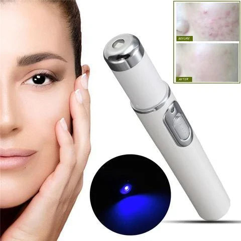 Blue Light Therapy Pen for Treating Acne, Scars, and Wrinkles - Portable Skincare Device with 415nm Blue Light, Heat, and Bio-Electric Current