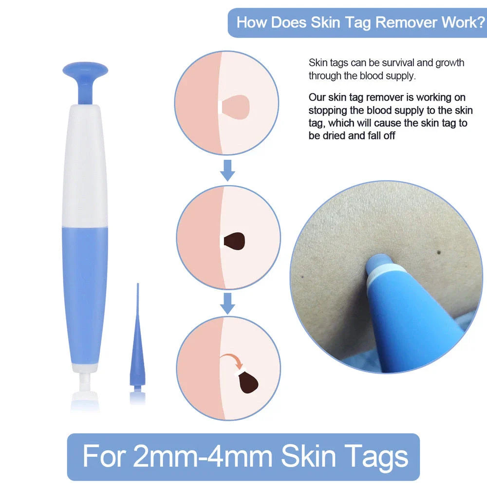 Premium skin tag remover tool with micro-band technology for safe and painless at-home skin tag treatment