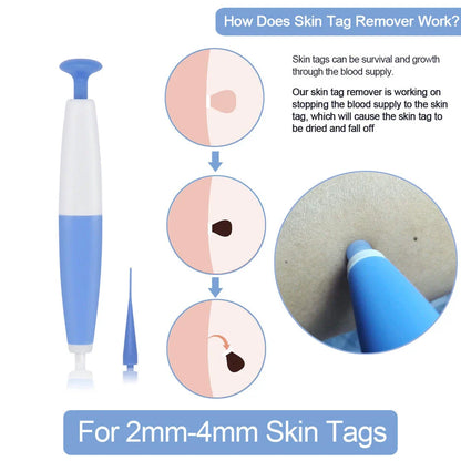 Premium skin tag remover tool with micro-band technology for safe and painless at-home skin tag treatment