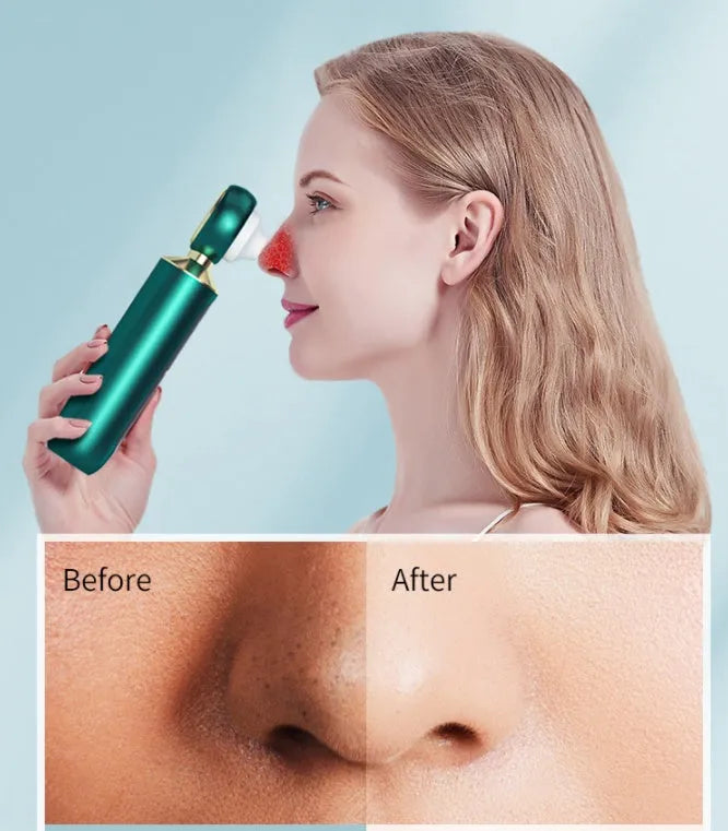 Portable visual blackhead remover with convex lens, three suction tips, and LED light in green